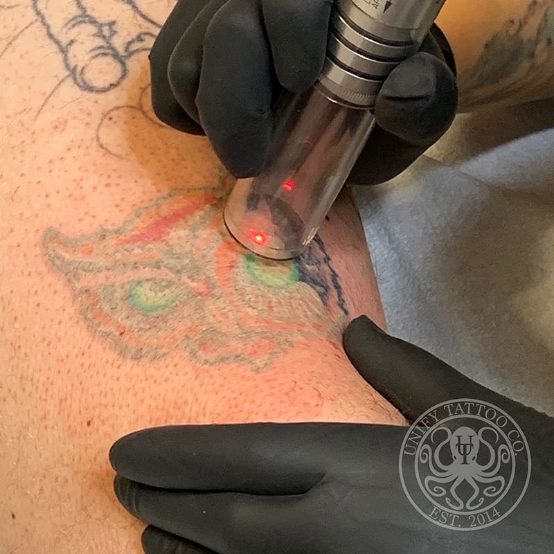 Laser Tattoo Removal
